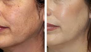 Skin Pigmentation Treatment in Dubai | Hyperpigmentation - Laser Skin Care Clinic  Dubai
